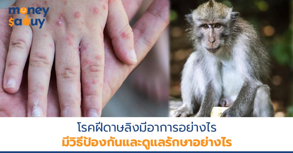โรคฝีดาษลิงมีอาการอย่างไร มีวิธีป้องกันและรักษาอย่างไร